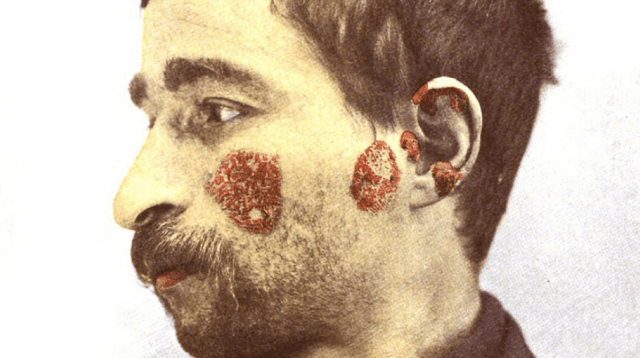 Steroid Usage on the Increases for Lupus Patients