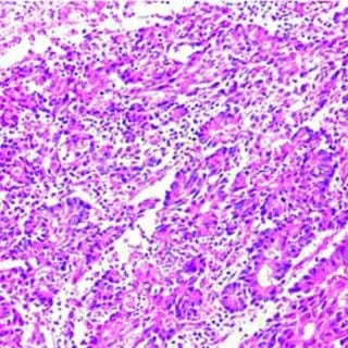 UK Approves Enhertu for Broad Use in HER2-Positive Advanced Cancers, Offering New Hope for Patients