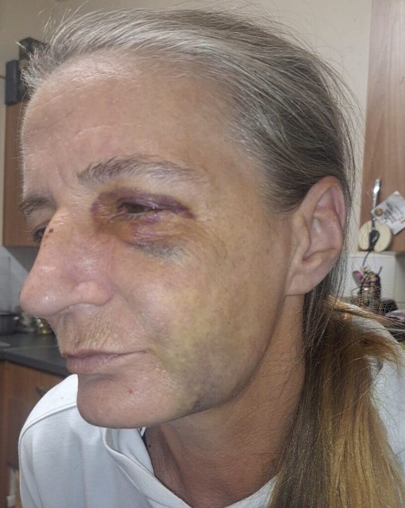 Woman Requires Surgery After Vicious Attack While Caring for Local Cats in Leyton