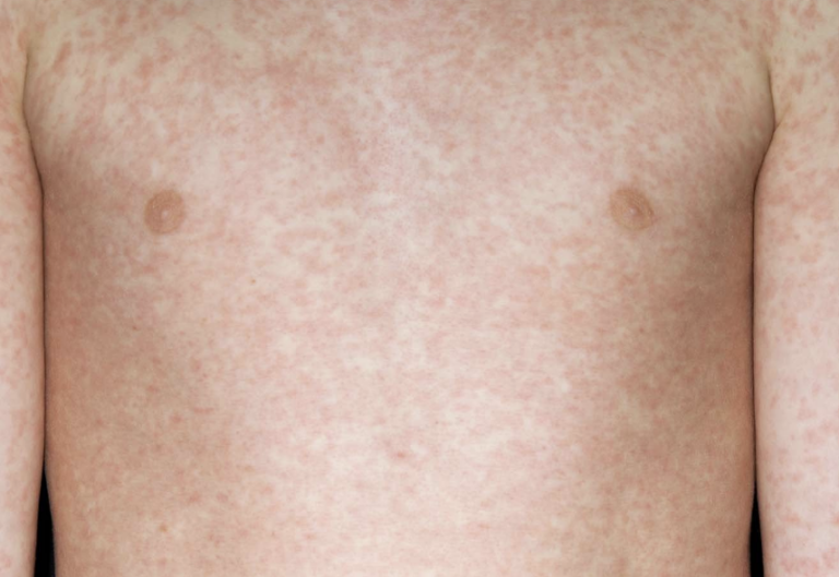 Two Children Die from Measles Amid Rising Cases Across UK