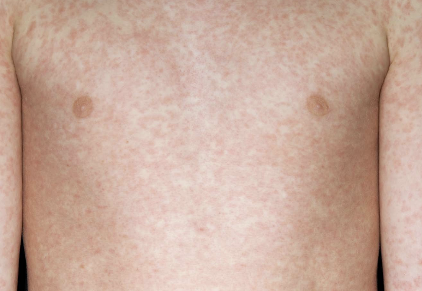 Two Children Die from Measles Amid Rising Cases Across UK