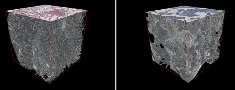 Advanced 3d Imaging Technique Applied For The First Time To Deadly Lung Disease