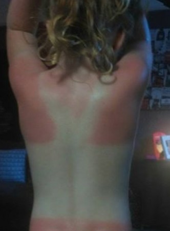 Sun Cream Warning After Child Left Badly Burnt